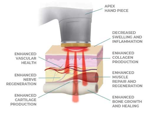 Process of Laser Removal
